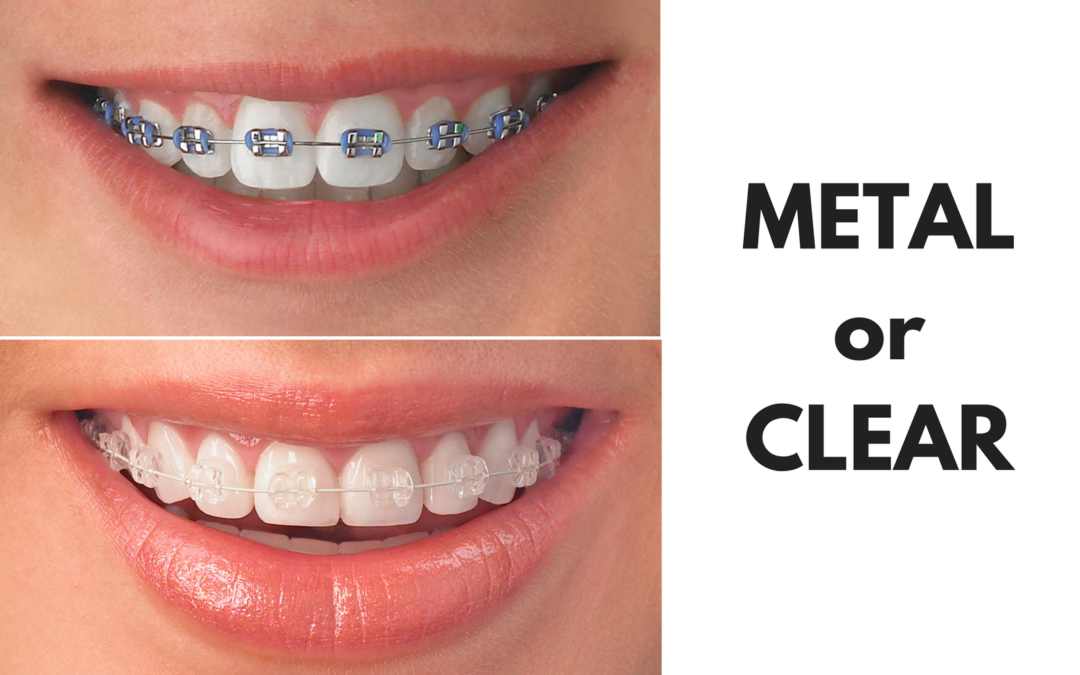 Ask Your Ennis Dentist: Should I Get Metal or Clear Braces?